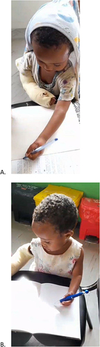 Figure 6 Postoperative functional outcome. (A) Twin A, (B) Twin B.