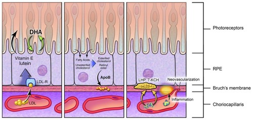 Figure 1 Left panel: carotenoids, vitamin E and cholesterol are delivered to the retinal pigment epithelium from the choriocapillaris. After initial processing within the retinal pigment epithelium, these molecules are presented to the photoreceptors. Central panel: continuous shedding of photoreceptor outer segments results in high levels of cholesterol and other lipids within the retinal pigment epithelium which, because of decreasing peroxisome activity with advancing age, are only partially metabolized. These are secreted toward the choriocapillaris, but some, particularly apolipoprotein B, accumulate within Bruch’s membrane. Right panel: lipid accumulation within Bruch’s membrane induces inflammation and ischemia, resulting in neovascular sprouting from the choriocapillaris.