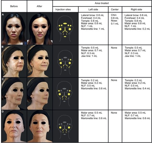 Figure 2 Before and after pictures of patients treated with the new-generation PCL-based collagen stimulator.