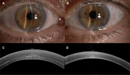 Figure 2 Biomicroscopic image of the patient’s eye after 24 months from Descemet stripping automated endothelial keratoplasty surgery (A, right eye; B, left eye). Both corneas are clear assessing the success of the transplant. Anterior segment optical coherence tomography images of right eye (C) and left eye (D) evidenced the different corneal thickness between the two eyes, 24 months post surgery.