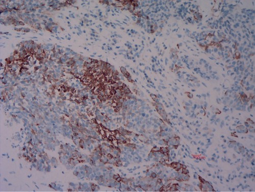 Figure 3 Immunohistochemistry of the cytokeratin (CK)–5/6 protein. The cells in the bottom left are tumor cells, whereas those in the top right are lymphocytes.