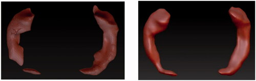 Figure 15. Fixing model imperfections of segmented data of the AD brain. Images show the models before (left) and after (right) the processing in the atrophied hippocampus.