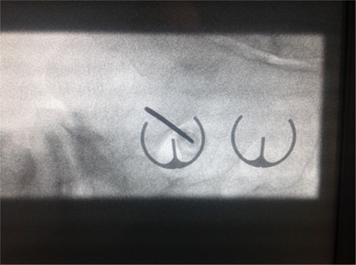 Figure 2 Sacroiliac joint cooled radiofrequency neurotomy.