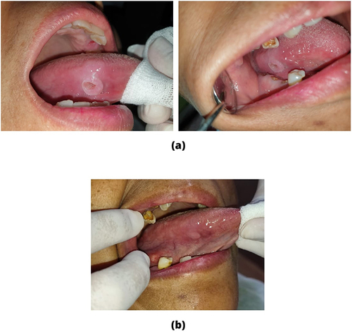 Figure 1 (a) Traumatic ulcer on lateral right of the tongue. There were some retained teeth close to the ulcer. (b) One week after first visit, the ulcer healed.
