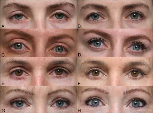 Figure 1 (A) A 31-year-old woman with hollow upper eyelid, high crease, and redundant platform skin after anterior levator ptosis surgery. (B) Same patient 12 months after crease-lowering ptosis surgery and mobilization of orbital fat. (C) A 44- year-old woman with ptosis, eyelash ptosis, indistinct upper eyelid crease, and compensatory brow elevation after multiple ptosis surgeries. (D) Same patient 12 months after crease-lowering ptosis surgery and mobilization of orbital fat into the reconstructed upper eyelid fold. (E) A 39-year-old woman after quadrilateral blepharoplasty with upper eyelid ptosis, eyelash ptosis, and a high crease. (F) Same patient 14 months after crease-lowering ptosis surgery, anchor blepharoplasty, and mobilization of orbital fat into the reconstructed upper eyelid fold. (G) A 46-year-old woman with upper eyelid ptosis, high upper eyelid crease, relative hollowing of the upper eyelid sulcus, and mild compensatory eyebrow elevation after blepharoplasty. Hyaluronic acid fillers are also present in the upper eyelid fold. (H) Same patient 12 months after crease-lowering ptosis surgery, anchor blepharoplasty, mobilization of orbital fat into the reconstructed upper eyelid fold, and removal of the hyaluronic acid filler with subsequent intraoperative injection of hyaluronidase.