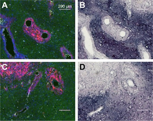 Figure 7 Directly injected AuNPs are largely found in the edema surrounding the tumor cells in peritumor region but not in and around the tumor cells themselves.Notes: (A and C) Left hemisphere and (B and D) left hemisphere, gold enhanced. (A–C) mCherry red (tumor, red), anti-albumin (edema, green), DAPI (nuclei, blue), and anti-CD31 (blood vessels, white) and (B and D) gold enhanced (gold stained, black).Abbreviations: AuNPs, gold nanoparticles; CD31, cluster of differentiation 31.
