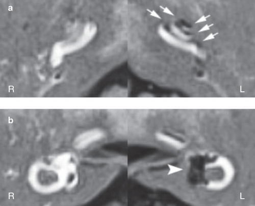 Figure 1. MRI scan for patient no. 17 (definite MD). The endolymphatic hydrops (ELH) is detectable as a black area inside the perilymphatic space filled with the gadodiamide in the left cochlea (a: arrows) and vestibule (b: arrowhead). In the right cochlea, the endolymphatic space (a significantly small area) is not detectable, probably due to strong signal intensity in the perilymphatic space. In the right vestibule, endolympatic space is detectable, but significantly smaller than that found in the left vestibule. [A detailed serial image movie can be seen at: http://www.shinshu-u.ac.jp/faculty/medicine/chair/ent/MRIleft.mov]