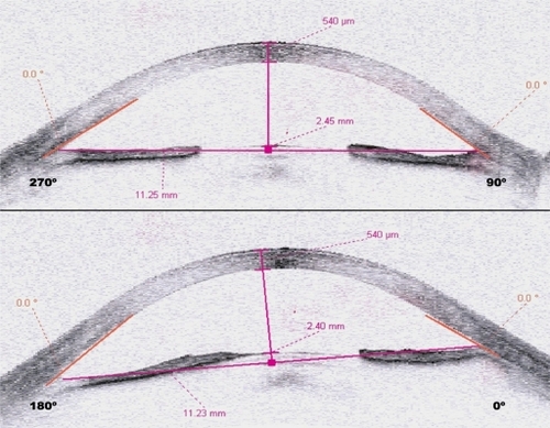 Figure 2 Case 5. Anterior segment optical coherence tomography obtained 48 hours following treatment showing complete angular closure.