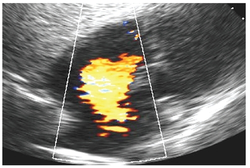 Figure 1 Transthoracic echocardiogram in the subcostal view with color Doppler flow imaging showing the large left to right shunt of a secundum atrial septal defect.