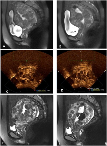 Figure 3. MRI obtained from a 27-year-old patient with DUL. (A&B) the pre-HIFU treatment T2-weighted imaging showed that the uterus,107mm × 85mm × 100 mm in size, was pervaded with tumors of varied sizes in the myometrium, which mainly was Isointense on T2WI. (C&D) the contrast-enhanced ultrasound showed non-perfusion in most of the leiomyomas immediately after HIFU treatment. (E&F)T2-weighted image revealed the uterus was 104 mm × 81mm × 89 mm in size, with a 17.6% shrinkage at 6 months compared to its initial volume prior to the treatment.