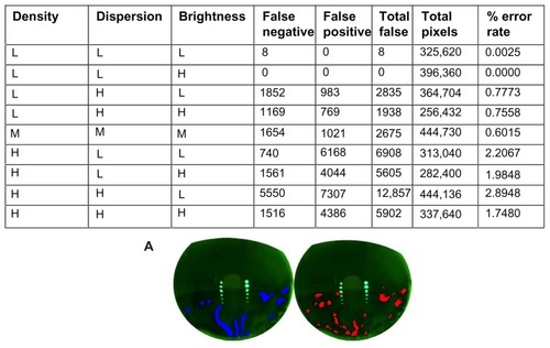 Figure 3 The OPI 2.0 System false positive and false negative errors and verification of the software analysis using actual videos collected. (A) Image of high density, high dispersion, and low brightness, with the technician-graded image in blue on the left and OPI 2.0 System output with the areas of detected simulated tear film breakup in red on the right.