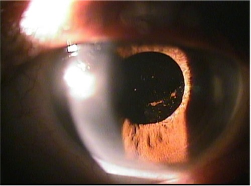 Figure 4 Clear external eye appearance without significant lesion at the last visit.