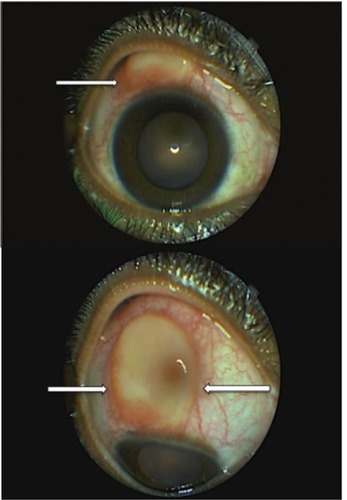 Figure 1 Right eye lesion before treatment with sulfasalazine.