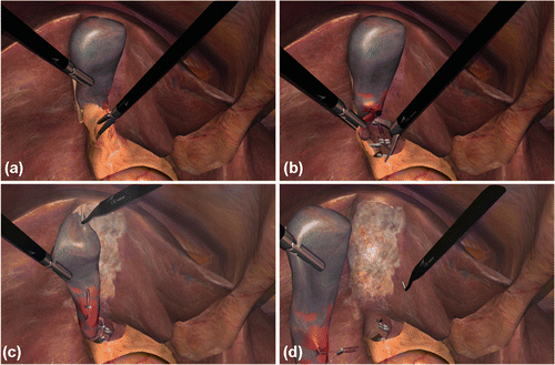Figure 1. Snapshots taken during the performance of the LC operation on the LapVR simulator: (a) dissection of the gallbladder; (b) clipping/cutting of the cystic duct/artery; (c) liver bed coagulation; and (d) gallbladder removal.