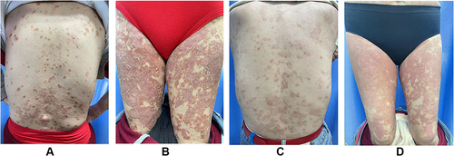 Figure 1 Clinical manifestation of the patient. (A) Multiple erythematous papules and plaques on the trunk. (B) Diffuse erythematous plaques on bilateral thighs. (C and D) Hyperpigmented patches and erythema on her back and limbs after secukinumab 150 mg per week.