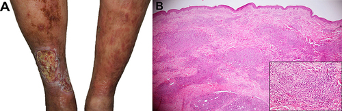 Figure 1 Granulomatous mycosis fungoides. (A) Clinical features demonstrate multiple ill-defined erythematous indurated plaques on both legs, the lesion on the right leg showed large overlying ulceration. (B) Atypical lymphoid cell infiltrate with granulomatous reaction on histology (H&E x40) (inset, x400).