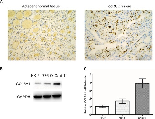 Figure 1 Expression of COL5A1 in tissue and cell lines.Notes: (A) Representative COL5A1 immunohistochemical images (200×) in adjacent normal tissue and ccRCC tissue. COL5A1 protein expression in the ccRCC tissue was significantly higher than that in the adjacent normal tissue. (B) Western blot detection of COL5A1 protein expression in HK-2, 786-O, and Caki-1 cells. COL5A1 protein was upregulated in ccRCC cell lines in comparison with HK-2 cells. GAPDH was used as loading control. (C) COL5A1 mRNA expression in HK-2, 786-O, and Caki-1 cells. The ccRCC cell lines showed a significantly higher COL5A1 mRNA expression in comparison with HK-2 (all P<0.05).Abbreviation: ccRCC, clear cell renal cell carcinoma.
