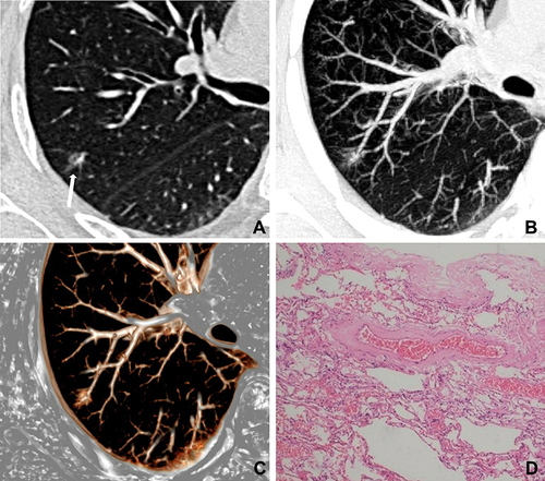 Figure 4 A 71-year-old woman with a nonabsorbable inflammatory nodule. (A) CT image shows a pure ground-glass nodule in the right upper lobe (white long arrow); (B and C) maximum intensity projection and volume rendering images show dilatation of intra-nodular vessels; (D) photomicrograph shows that the dilated vessels corresponded to the thickening of vessel walls with slight proliferation of fibrous tissue surrounding vessels (hematoxylin-eosin stain, original magnification, ×100).