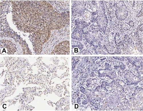 Figure 2 Representative images of PTK6 immunostaining in this study. (A) High level of PTK6 in NSCLC tumors; (B) low level of PTK6 expression in NSCLC tumors; (C) PTK6 expression in adjacent normal lung tissues; (D) negative control for immunostaining (IgG).