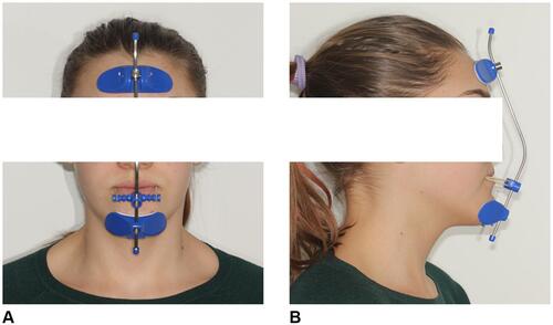 Figure 10 Patient wearing the facemask. (A) Frontal view. (B) Lateral view.