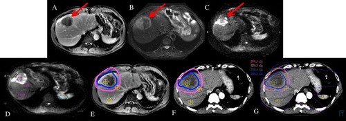 Figure 1.  Typical Baseline Imaging. Top Row: Baseline T2 (A), DWI b300 (B) and DWI b600 (C). Images obtained with exhale breath-hold through same axial region of the tumour. Bottom Row: Typical ROI selection in tumour, peri-tumour and irradiated liver on ADC map (D), gadolinium enhanced T1 (E), contrast enhanced planning CT with (F) dose map. Gross tumour volume and planning target volume shown on T1 MRI and CT in blue and pink contours respectively.