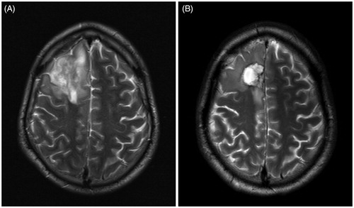 Figure 1. Case 1: preoperative MR T2 image (A) and postoperative MR T2 image (B).