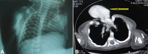 Figure 4 Shows (A) post-delivery chest x-ray of the patient. (B) Post-delivery computed tomography scan showed the Pentalogy of Cantrell (arrow).