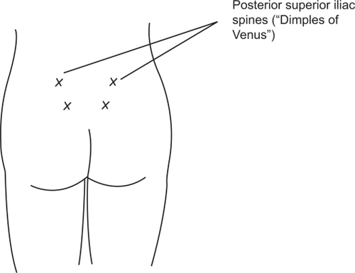 Figure 3 Placement of intradermal water blocks: 4 intradermal injections of 0.05 to 0.1 mL of sterile water to form 4 small blebs over each posterior superior iliac spine and 3 cm below and 1 cm medial to each spine. The exact locations of the injections do not appear to be critical to the block success. Reprinted with permission from Simkin P, Bolding A. Update on nonpharmacologic approaches to relieve labor pain and prevent suffering. J Midwifery Womens Health. 2004;49(6):489–504.Citation19 Copyright © 2004 Elsevier.
