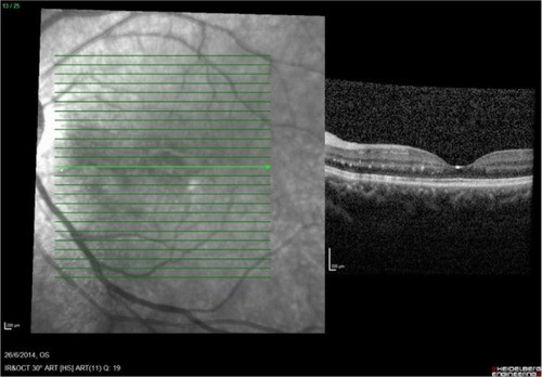 Figure 4 Optical coherence tomography of the left eye showed resolution of subretinal fluid at the macula at 1 week posttreatment. The scale represents the corresponding measurement of 200 mm vertically and horizontally.
