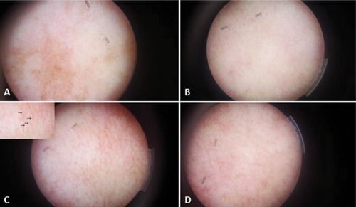 Figure 4 Dermoscopic photomicrographs of melasma lesions (original magnification ×15): (A) at baseline, (B) 12 weeks after starting treatment with fractional Er:YAG laser + HQ cream, (C) at baseline showing telangiectasias (arrows in inset), and (D) 12 weeks after starting treatment with HQ cream alone.