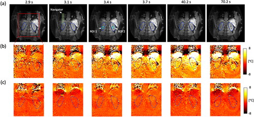 Figure 7. The result of healthy volunteer experiments without heating (volunteer #1). (a) A coronal slice is acquired and shows the left and right kidney organs which are indicated with blue dashed lines. PRFS temperature maps show that a (c) multi-baseline PRFS reconstruction allows stable and homogeneous temperature measurements, compared to a (b) single baseline (see Supporting Material Video S1). A pencil beam navigator is placed at the boundary of the diaphragm to measure a respiratory motion position.