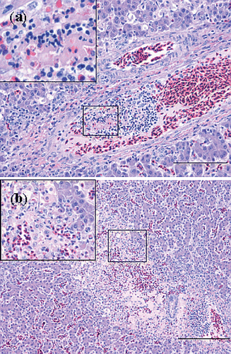 Figure 6. Haematoxylin and eosin sections of thrombotic lesions in the liver from birds with E. hirae-associated endocarditis. with (a) thrombosis of a periportal vein: insert showing a thrombus being composed of fibrin and debris and disintegrating heterophils present in the thrombus (bar = 100 µm), and (b) subacute process consisting of focal coagulative necrosis with heterophil infiltration and large mesenchymal cells, possibly activated Kupffer cells, and infarction with erythrocytes: insert showing necrosis, mesenchymal cells and heterophils (bar = 200 µm).