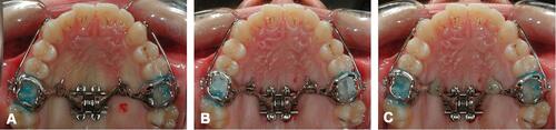 Figure 7 Positioning of MSE appliance in the oral cavity. (A) After cementation of molar bands. (B) After positioning of 6 miniscrews and tie with 0.010 steel ligature between head of lateral miniscrew and bushing pin. (C) After positioning of composite flow on top of lateral miniscrew heads and bushings.