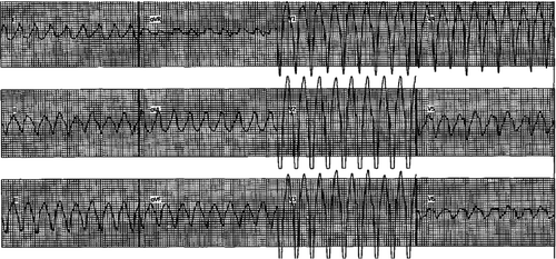 Figure 5. Twelve-lead EKG showing inducible ventricular tachycardia with left bundle branch block pattern and superior axis during electrophysiologic study.