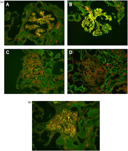 Figure 4. Immunofluorescence staining of ISG20 in renal biopsy specimens obtained from patients with non-proliferative LN, proliferative LN, IgA nephropathy, and minimal-change nephrotic syndrome. Dual immunostaining of ISG20 (green) and CD34 (red) in renal biopsy specimens. (a) Upper left, non-proliferative lupus nephritis (LN) [Class II in accordance with the International Society of Nephrology/Renal Pathology Society (ISN/RPS) 2003 classification for LN]; upper right, proliferative LN [Class IV-G (A) in accordance with the ISN/RPS 2003 classification for LN]; lower left, IgA nephropathy; and lower right, minimal-change nephrotic syndrome (served as a non-inflammatory control). A significant increase in ISG20 immunoreactivity was observed in proliferative LN specimens, whereas immunoreactivity was weak or negligible (upper right corner) in the other specimens (×400 magnification). (b) In proliferative lupus nephritis, positive staining for ISG20 (green) was detected mainly in the endothelial area (×400 magnification).