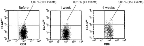 Figure 1. FACS plot of Melan-A/Mart-1 specific CD8+ T-cells (Patient 1) using phycoerythrin conjugated ELAGIGTV-pentamer. The results show an increase from 1.09% before isolated limb perfusion to 6.08% after 4 weeks.