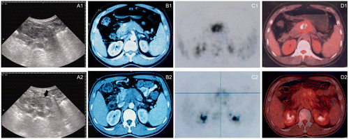 Figure 4. (A) Greyscale changes of HIFU obtained from real-time ultrasound (US) images during the HIFU procedure. (A1) US image obtained before HIFU showing a large pancreatic carcinoma lesion present in the body of pancreas. (A2) US images obtained immediately after the HIFU procedure showing a lumpish change (arrow) in one slice of the lesion. (B1) A CT scan made before HIFU demonstrating a tumour in the body of pancreas. (B2) A CT scan representing no significant size change one month after HIFU treatment and the necrotic area having the same greyscale change shown by US. (C1, D1) A PET-CT scan made before HIFU demonstrating a SUVmax of 7.8 g/mL. (C2, D2) The PET-CT scan made 1 month after HIFU showing coagulation necrosis of the tumour and a decrease in the SUVmax value to 3.5 g/mL. All images were taken from the same patient. The Pavg of HIFU for this patient was 237 W and DI was 9.9 kJ/cm3.