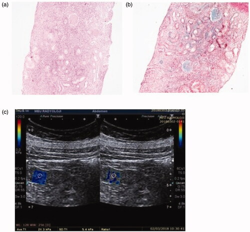 Figure 3. Patient 3: light microscopic images of renal tissue that stage T2 (severe IFTA)-stage F1 (moderate IF) and their SWE image. (a) H&E ×200. (b) Masson’s trichrome ×200. (c) YM = 21.3 kPa (compatible with the stage F1 (moderate IF)).