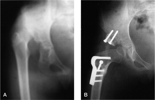 Figure 3 Case 7. A 12-year-old girl at the index operation (A) for dislocation of the right hip and after open reduction, capsulorrhaphy, extraarticular grafting arthroplasty and femoral shortening (B), showing adequate reduction.