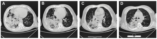 Figure 1 Computerized tomography was performed when the patient was admitted to the hospital. CT showed a dense consolidation site in the right lung, accompanying by mediastinal and right hilar lymphadenopathy.