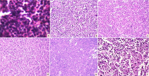 Figure 1. A panel of photomicrographs depicting various non-Hodgkin lymphomas according to the Working Formulation: (a) malignant lymphoma (ML) small lymphocytic (H&E, ×100); (b) ML follicular predominantly small cleaved cells (H&E, ×100); (c) ML follicular predominantly large cells (H&E, ×100); (d) ML diffuse large cell (H&E, ×100); (e) ML lymphoblastic (H&E, ×100); and (f) ML diffuse mixed small and large cells (H&E, ×100).
