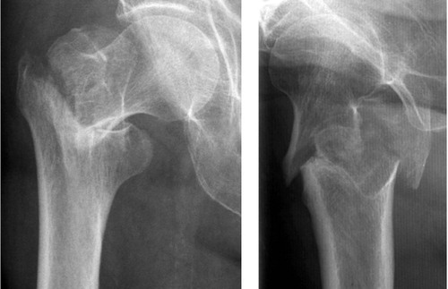 Figure 2. An 82-year-old woman sustained a pertrochanteric hip fracture with a detached greater trochanter.