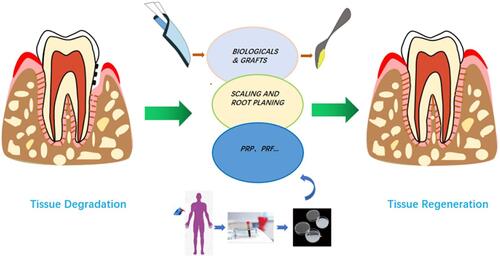 Figure 3 Endogenous tissue engineering for periodontal regeneration.