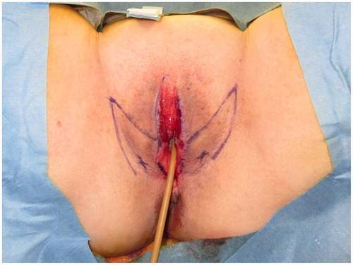 Figure 2. A 3 × 7 cm vulvoperineal flap that incorporates the perforator from the superficial external pudendal artery as the vascular pedicle was designed.
