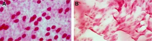 Figure 1 Representative PAS-and H and E-stained images at 400× magnification showing (A) a normal number and morphology of goblet cells (Grade 0) (B) squamous metaplasia (Grade 3).