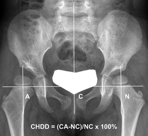 Figure 2. Measurement of center–head distance discrepancy (CHDD) on anteroposterior radiograph of the hip. The CHDD was defined as the difference in the center–head distance between the DDH side and the normal side, and expressed as a percentage of the normal side measurement.