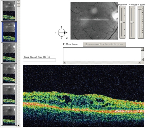 Figure 2b Optical coherence tomography image of a macula exhibiting diabetic macular edema. Thickening of the sensory retina is evident along with typical focal cystoid changes, seen as optically clear cavities within the retina. The foveal depression is lost due to edema.