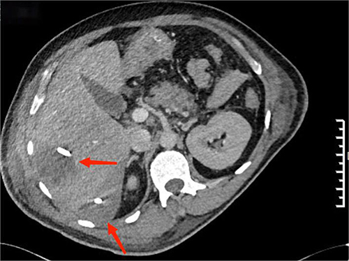 Figure 4 Computed tomography of the abdomen after drainage of liver abscess. Liver abscesses in both areas of the right hepatic lobe have shrunk (marked by red arrows).