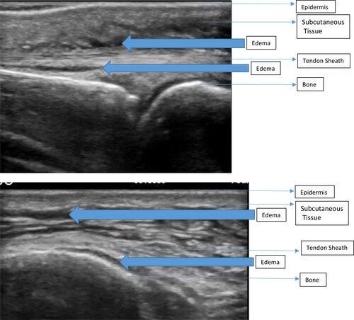 Figure 3 . Edema at the extensor tendon. Figure 4. Edema in the subcutaneous space.