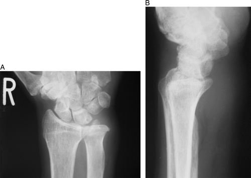 Figure 1.  Anteroposterior (A) and lateral (B) radiogram of the right wrist shows the soft tissue mass on the palmar side without calcification.